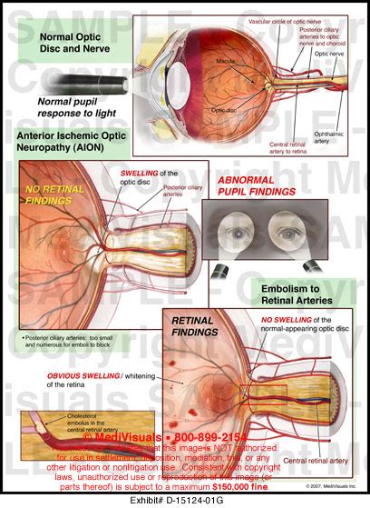 Ischemic Optic Neuropathy