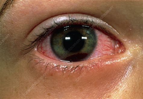 Hyphaema of the eye caused by a trauma - Stock Image - M155/0425 ...