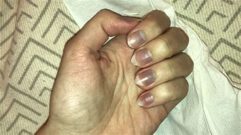 Blue fingernails and feeling very cold 24F – Cyanosis? Raynaud syndrome ...