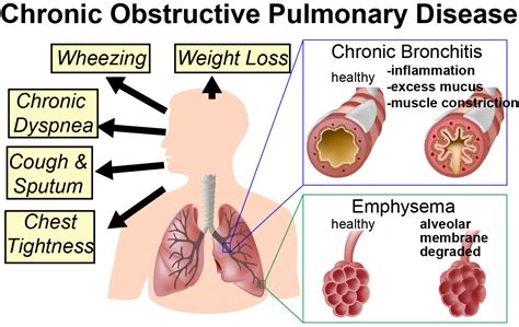 Molecular Mechanisms of Inflammatory Signaling in COPD