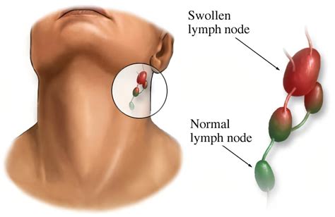 Swollen Lymph Nodes: How Can Ayurveda Help? - Yatan Ayurveda