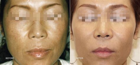 Laser Skin Resurfacing | Repair Skin | Albuquerque, NM