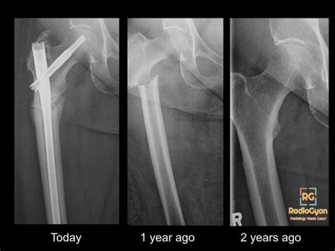 Atypical Femoral Fracture - What Radiologsits Need to Know!