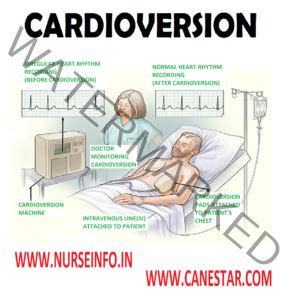 CARDIOVERSION - Nurse Info