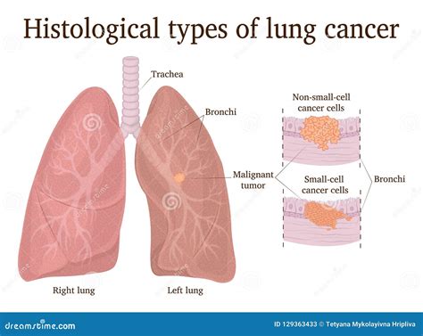 Cancer Cell Types