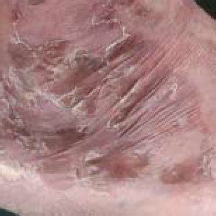 Necrolytic migratory erythema with typical scaling, erythema and ...