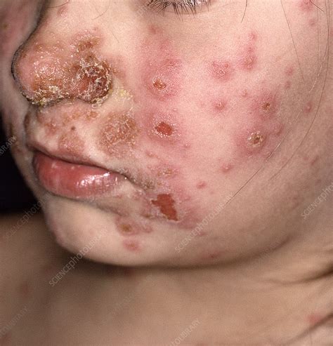 Impetigo - Stock Image - C051/6910 - Science Photo Library