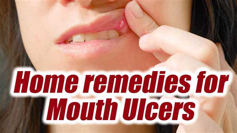 Mouth Ulcer, Home Remedies to treat them; Check out here | Boldsky - YouTube