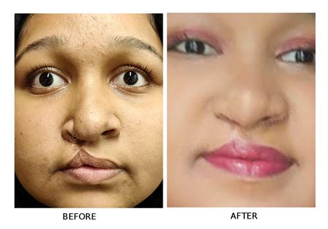 Cleft Lips Before And After Surgery | Lipstutorial.org