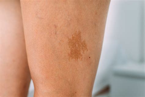 Unlocking the Secrets: The Meaning of Birthmark on Back - Itechment