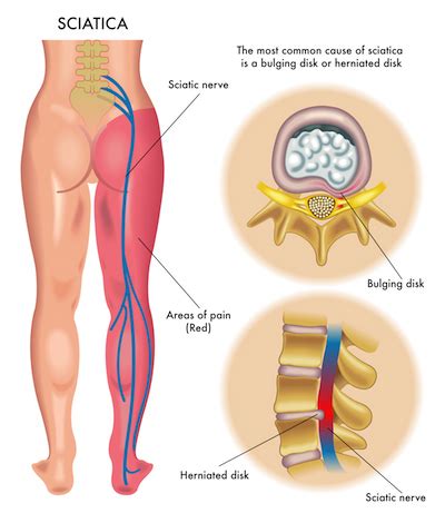 Lumbar Radiculopathy Sciatica | Spine Options - A Center for Non-Surgical Care of Back and Neck Pain