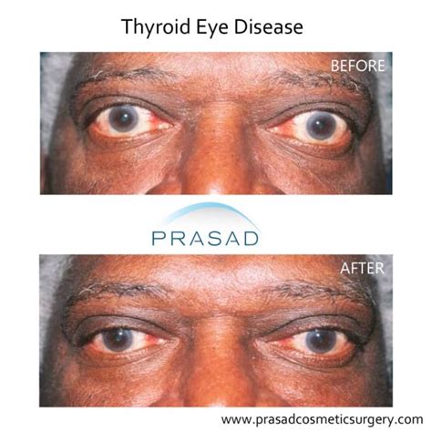 Thyroid Eye Disease Surgery/ Graves Eye Disease Surgery