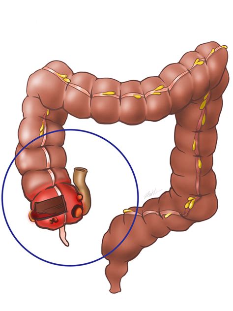 Adenocarcinoma: Cecal Adenocarcinoma