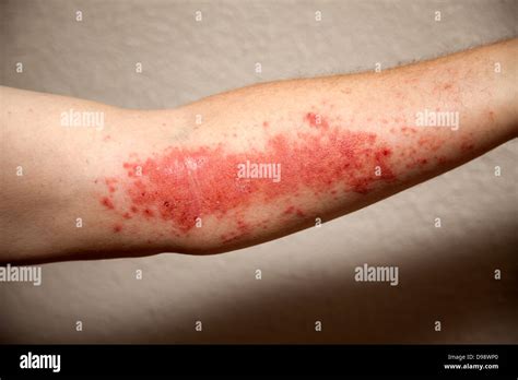 Poison Ivy Rash On Arm