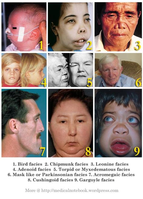 Facies in different medical conditions | Medical conditions, Medical ...