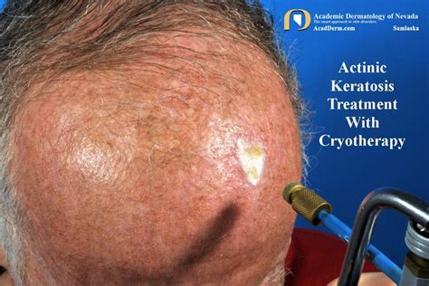 Actinic Keratosis: Treatment-Cryotherapy - Academic Dermatology of Nevada