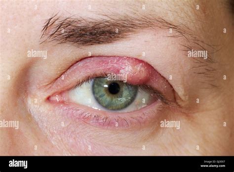 Chalazion Upper Eyelid