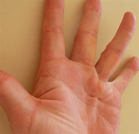 Palmar Erythema - Pictures, Definition, Causes, Treatment