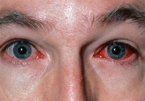 Inflamed eyes caused by conjunctivitis - Stock Image - M155/0250 - Science Photo Library