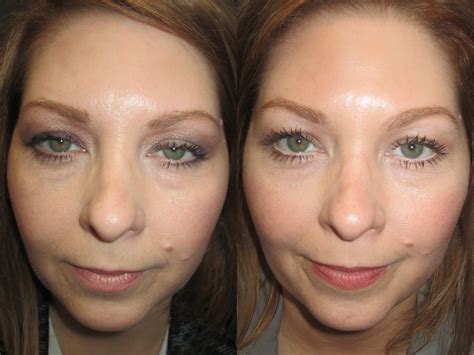 Droopy Eyelids Atlanta | Ptosis Surgery Atlanta | OPAL Aesthetics