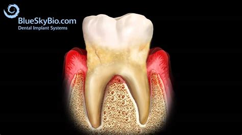 Patient Treatment Videos: Perio Disease - YouTube