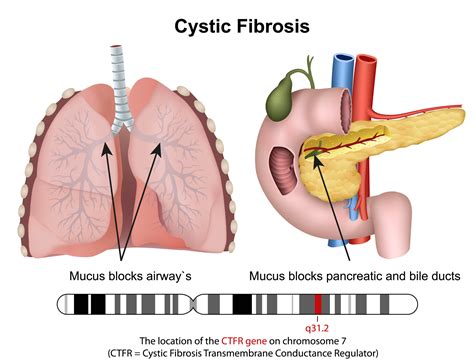 Cystic Fibrosis: Causes, Symptoms, Diagnosis and Treatment - Online ...