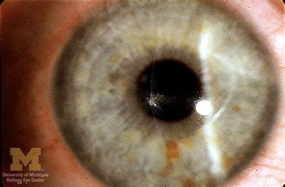 Corneal Abrasion : Eye Trauma : The Eyes Have It