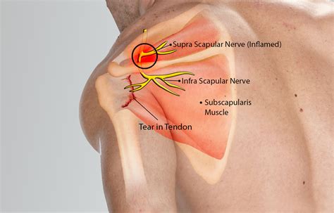 Suprascapular Nerve Block | Su Spine & Sports