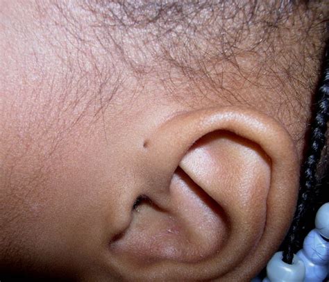 Preauricular Pits: A Hole in Your Child's Ear