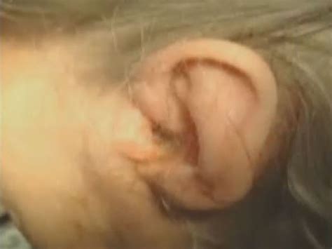 92-year-old has 57 maggots removed from ear, family sues nursing home ...