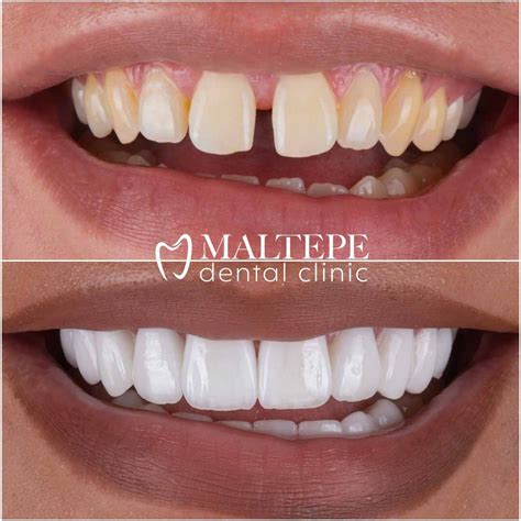 Emax Veneers Experience in Istanbul - Maltepe Dental Clinic