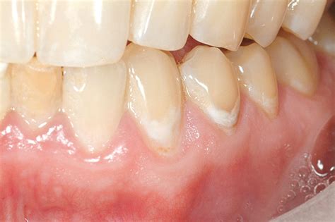 What is incipient caries? | News | Dentagama