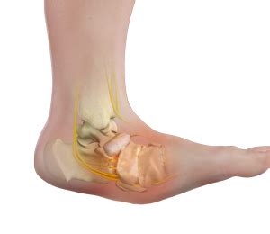 Charcot Foot Deformity | Advanced Orthopaedics & Sports Medicine, Orthopaedic Specialists ...