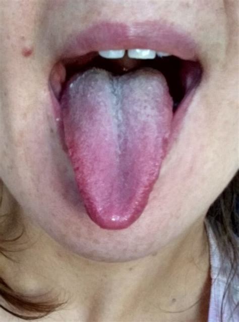 Lyme, Out!: Candida Tongue Check, after one month of treatment.