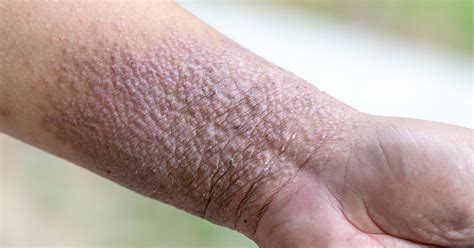 How Do You Treat Pustular Psoriasis - ScienceHUB