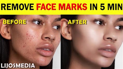 REMOVE FACE MARKS IN 5 MINUTES | CLEAN FACE | AWESOME | BEAUTIFUL FACE ...