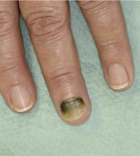 Green Nail Syndrome (Pseudomonas aeruginosa Nail Infection): Two Cases ...