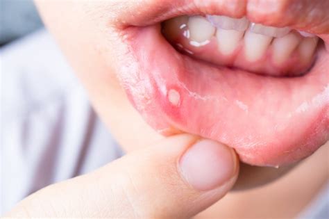 What Causes Cold Sores & Canker Sores Braintree | Pinnacle Dental