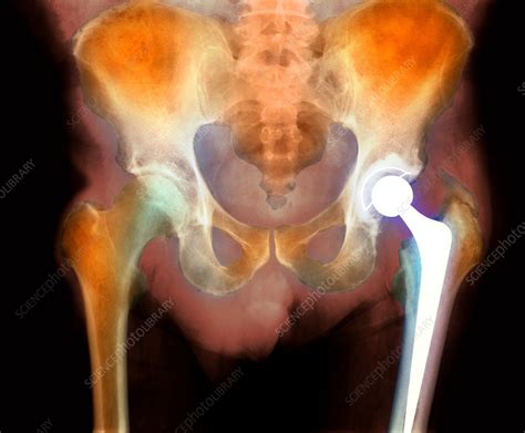 Hip joint replacement, X-ray - Stock Image - M600/0322 - Science Photo ...