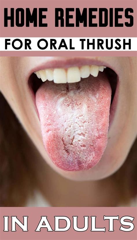 White Tongue Symptoms Causes Treatment - vrogue.co