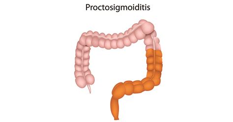 Proctosigmoiditis? | Ulcerative Colitis | IBDrelief