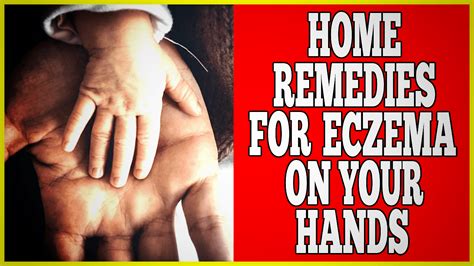 Home Remedies For Eczema On Hands - Clinton Conley