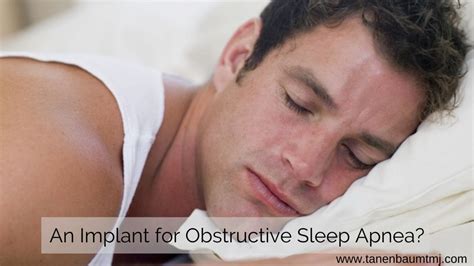 An Implant for Obstructive Sleep Apnea? - Donald R. Tanenbaum, DDS MPH