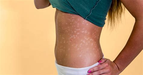 Guttate Psoriasis: Pictures, Causes, Treatment, and More