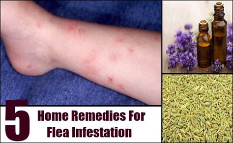 5 Home Remedies For Flea Infestation Home Remedies For Fleas, Women ...