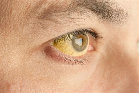 Yellow eyes: Causes in newborns, children, and adults