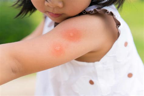 Identifying Different Insect Bites - Green Pest Services