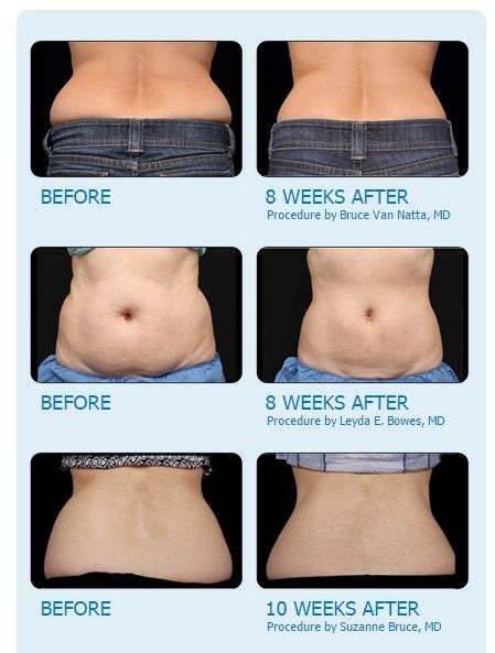 CoolSculpting--Fat Freezing