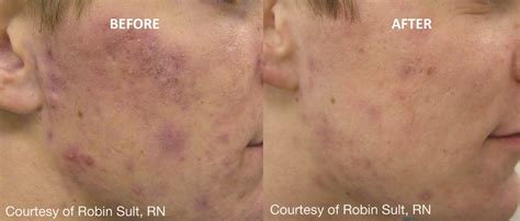 ACNE MEN BEFORE AND AFTER - Revive Laser and Skin Clinic