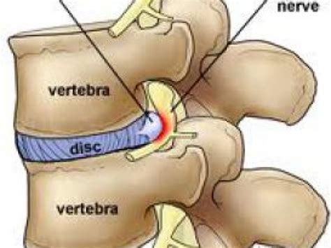 How to Treat a Bulging Disc in Your Lower Back | Middletown, CT Patch